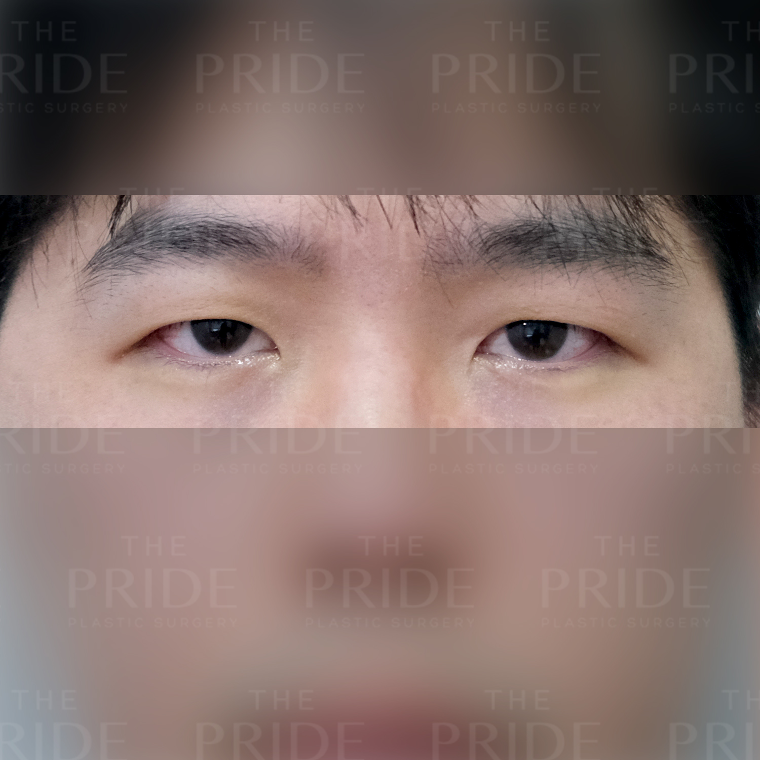 눈성형