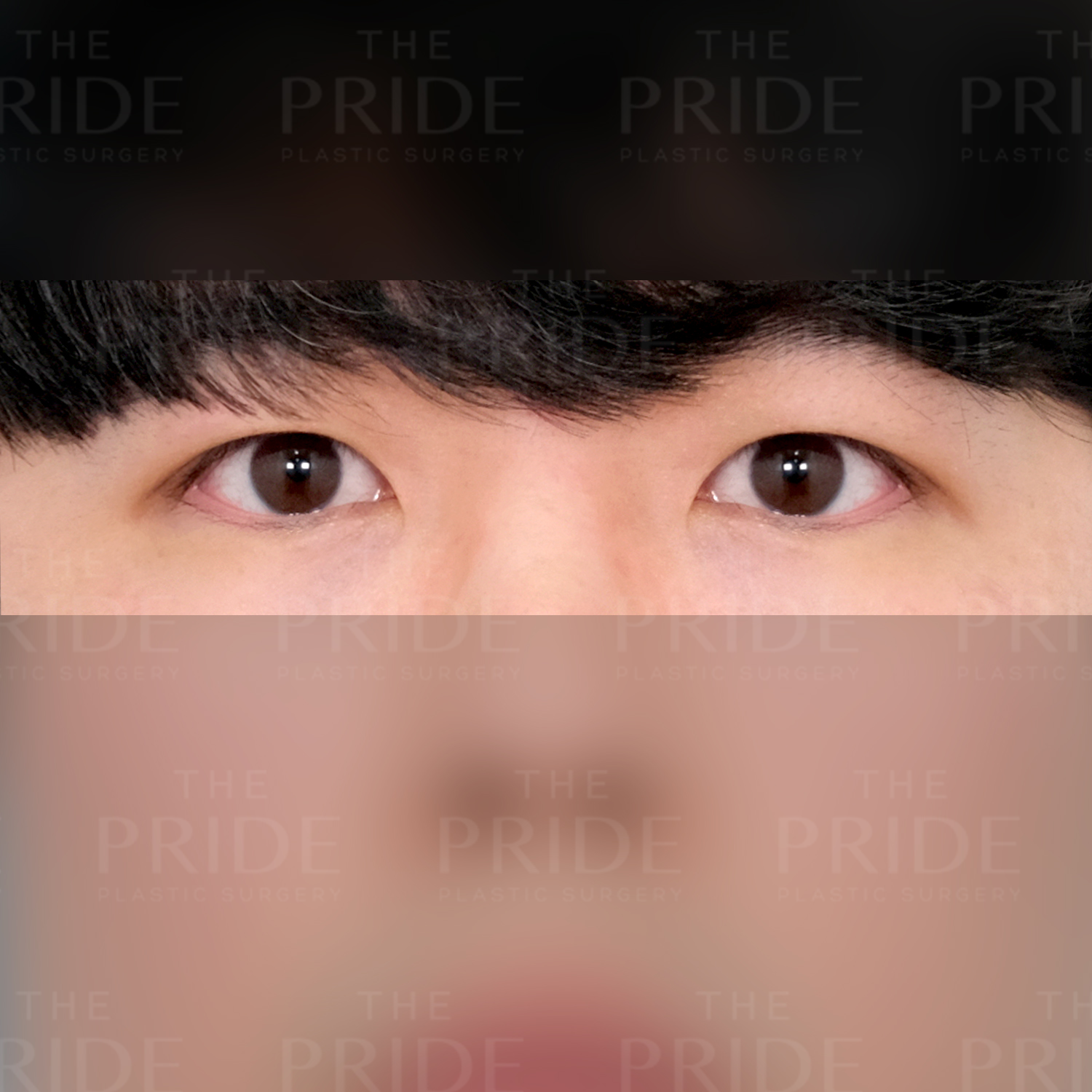 눈성형