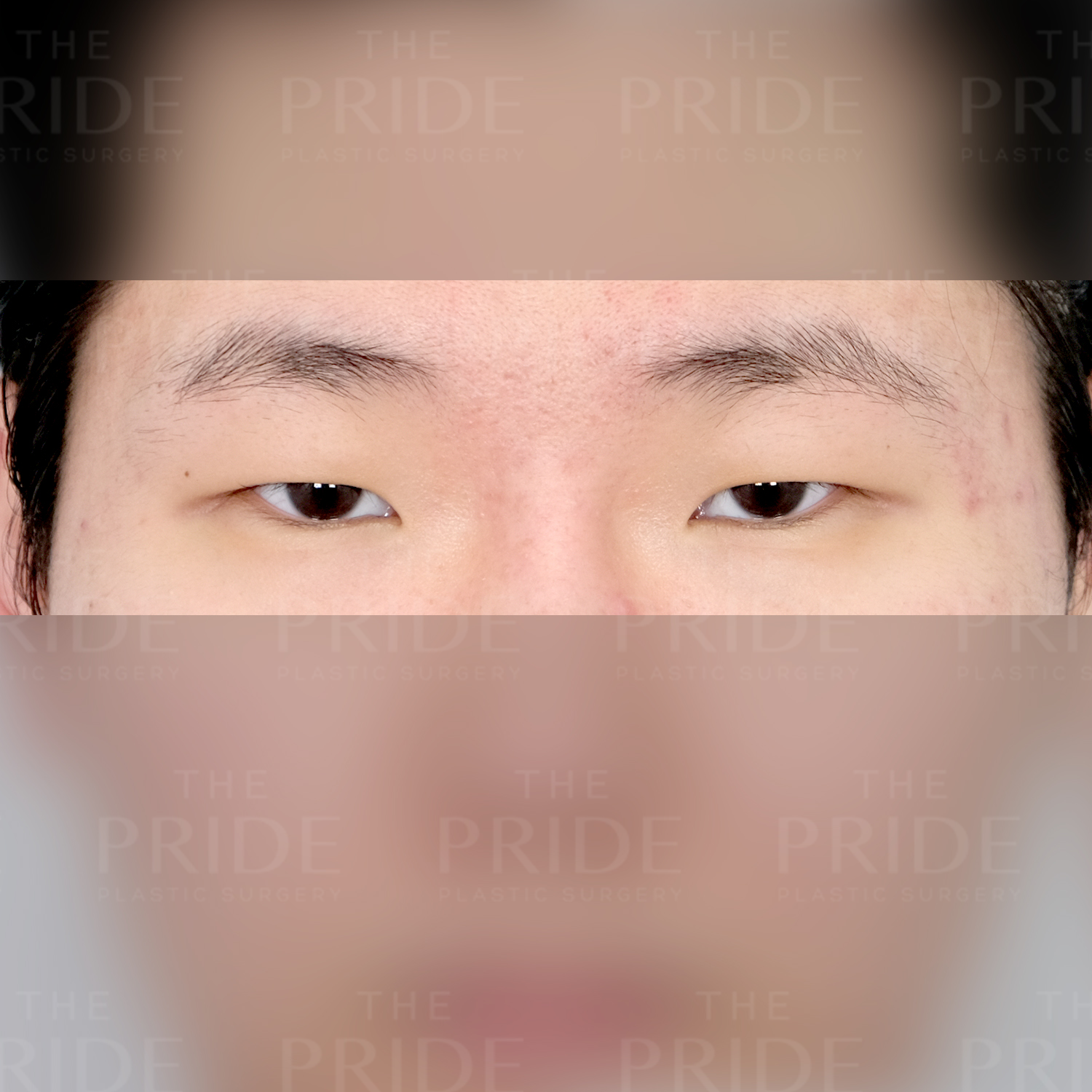 눈성형