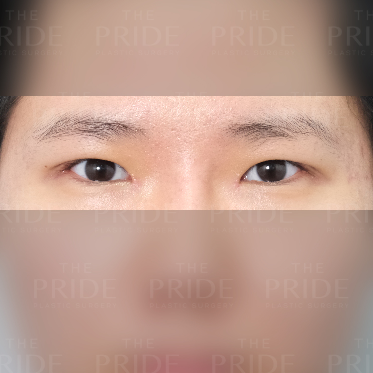 눈성형