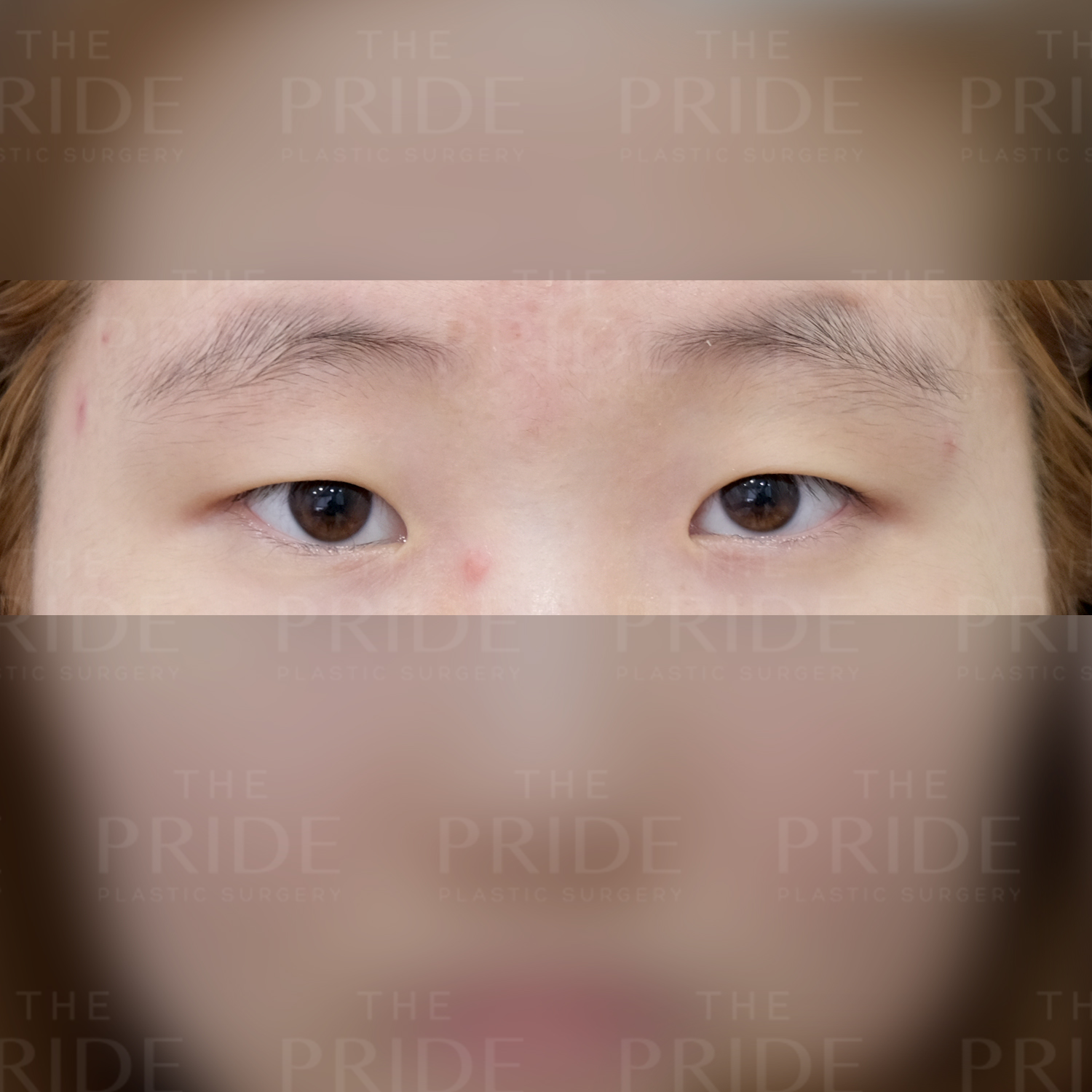 눈성형