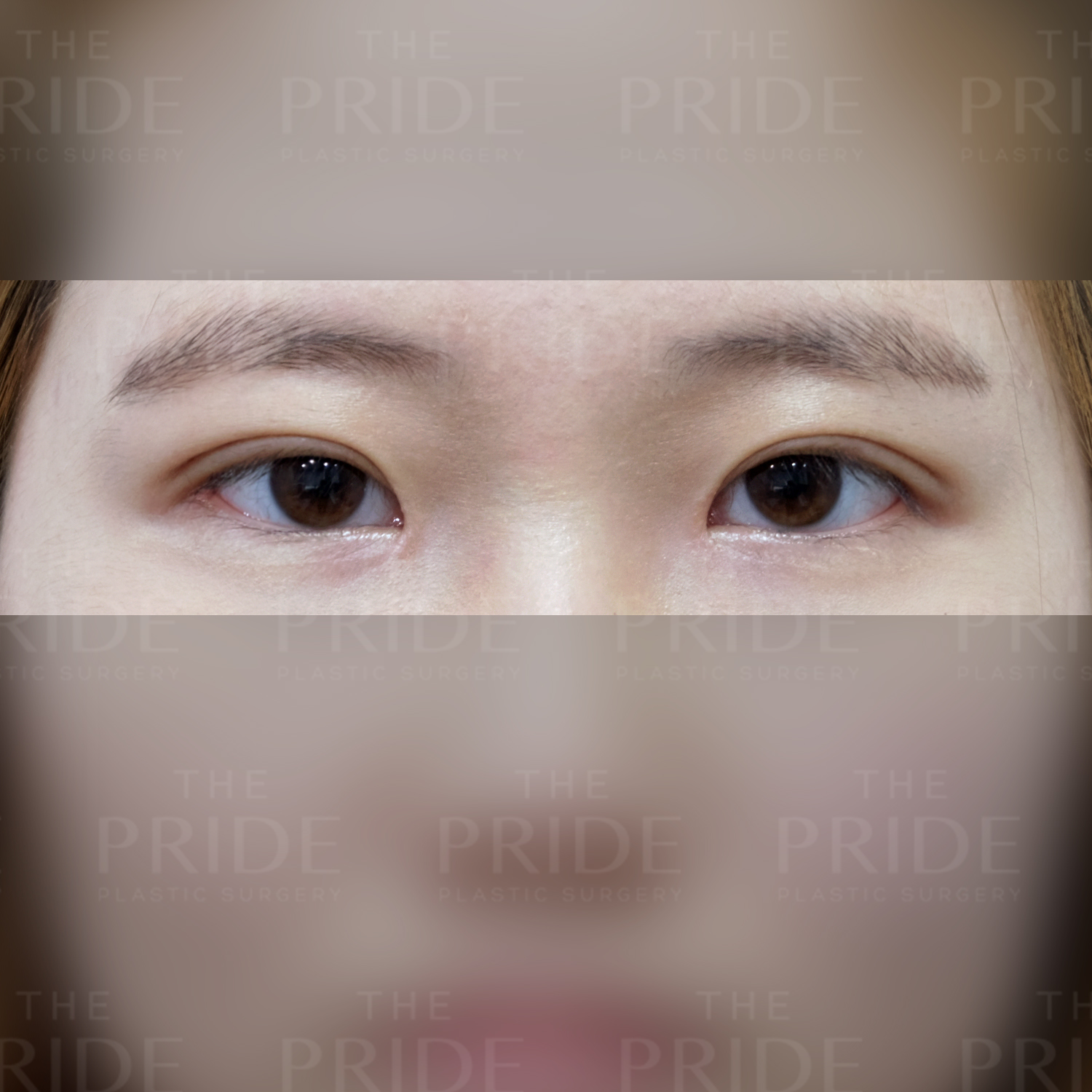 눈성형