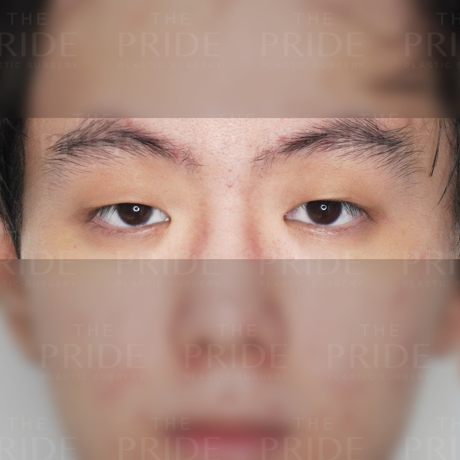 눈성형