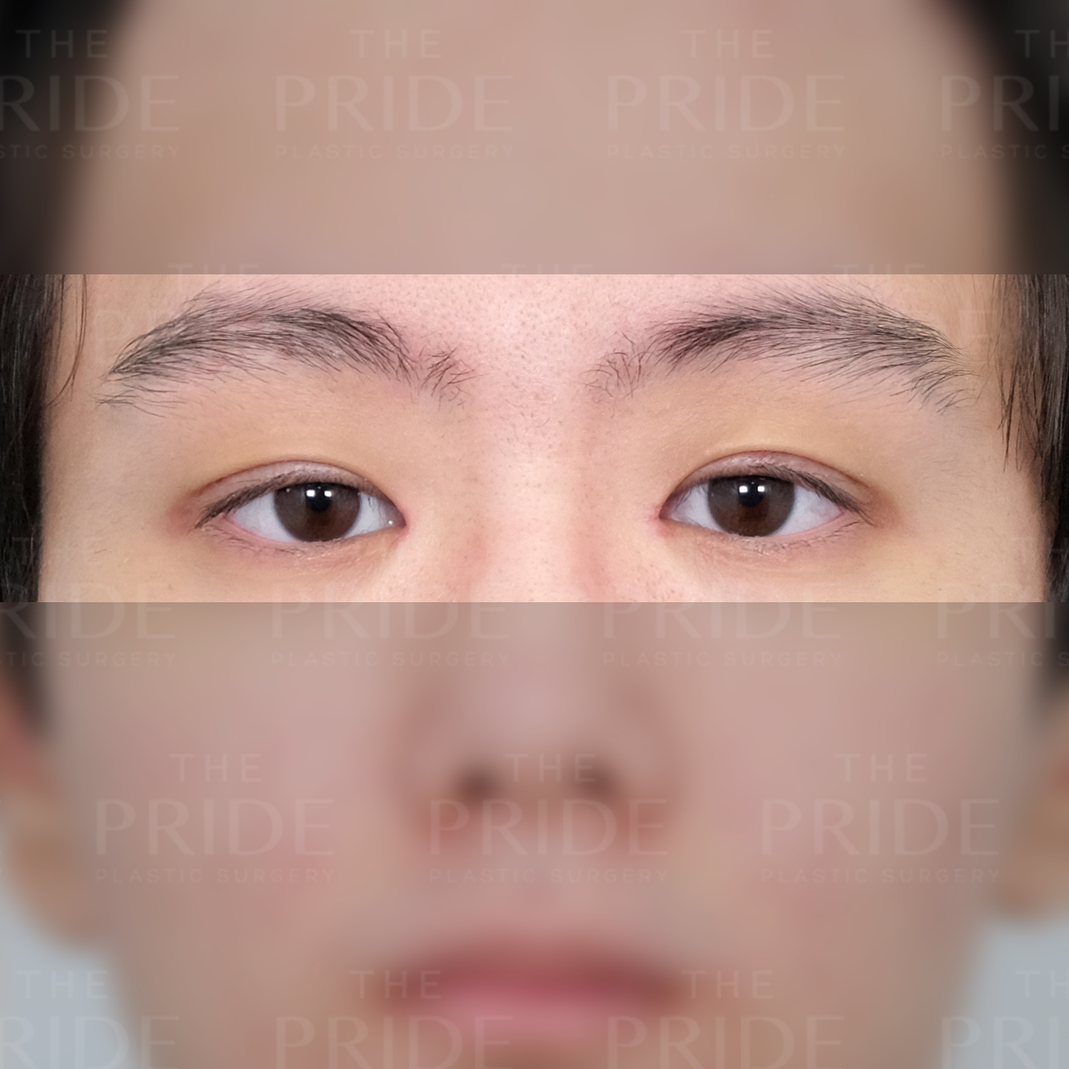 눈성형