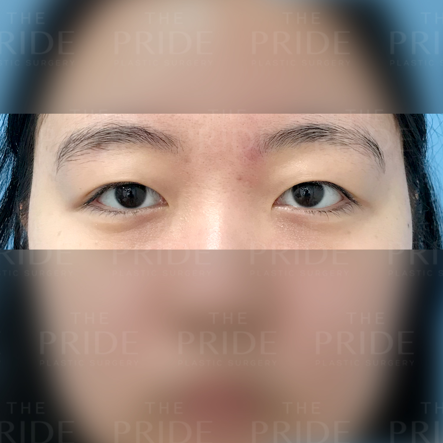 눈성형