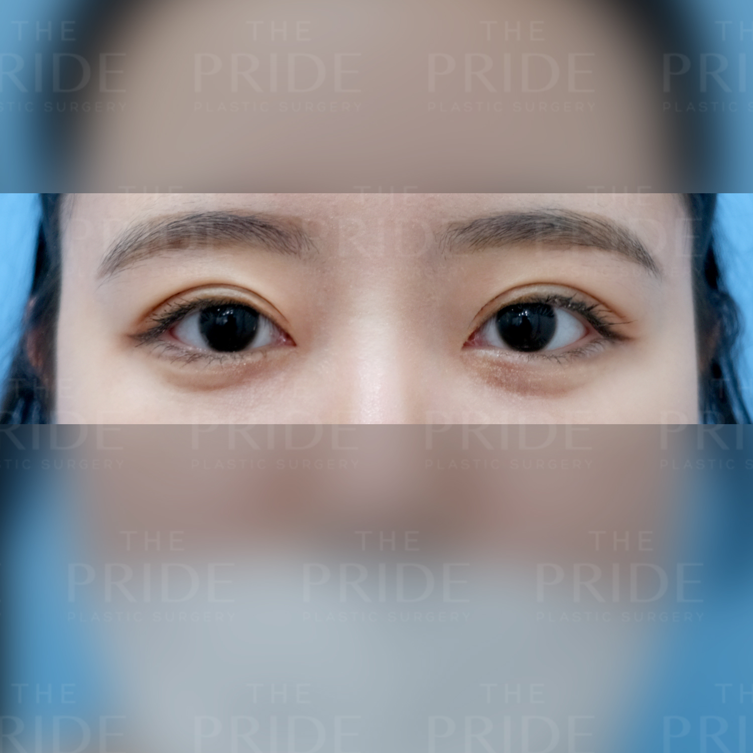 눈성형