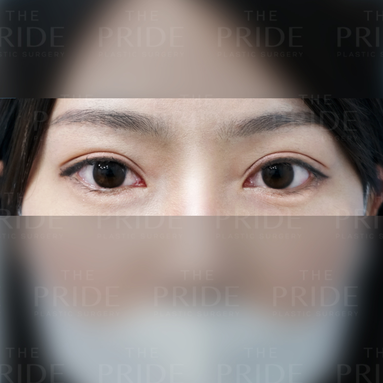 눈성형