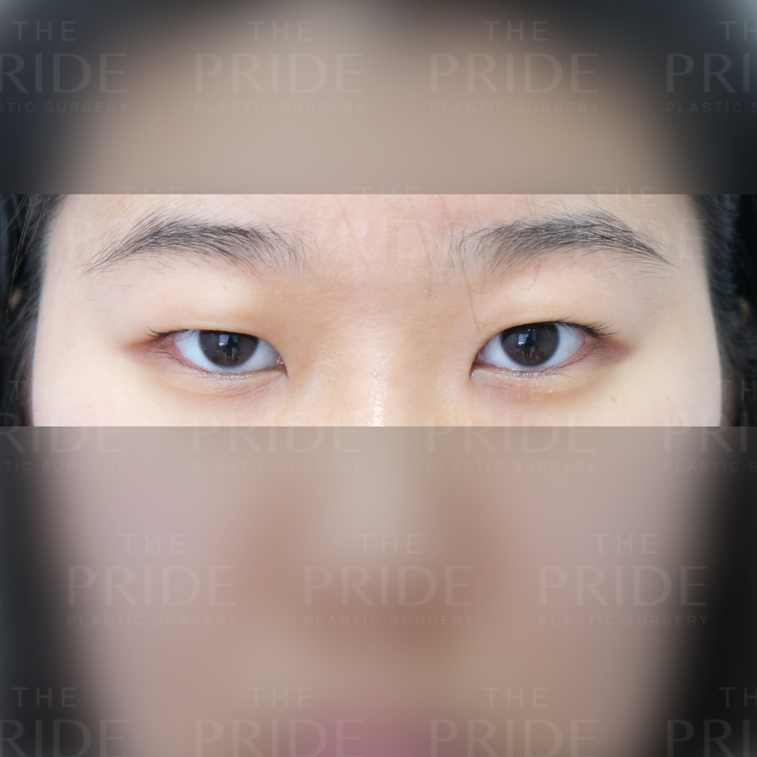 눈성형