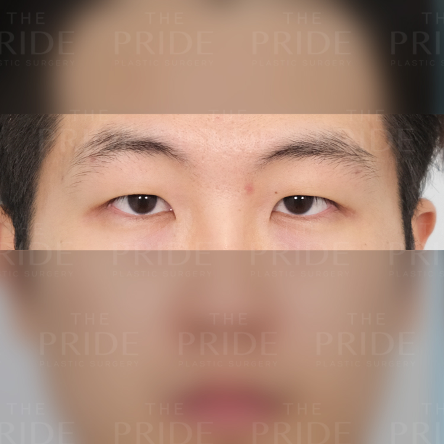 눈성형