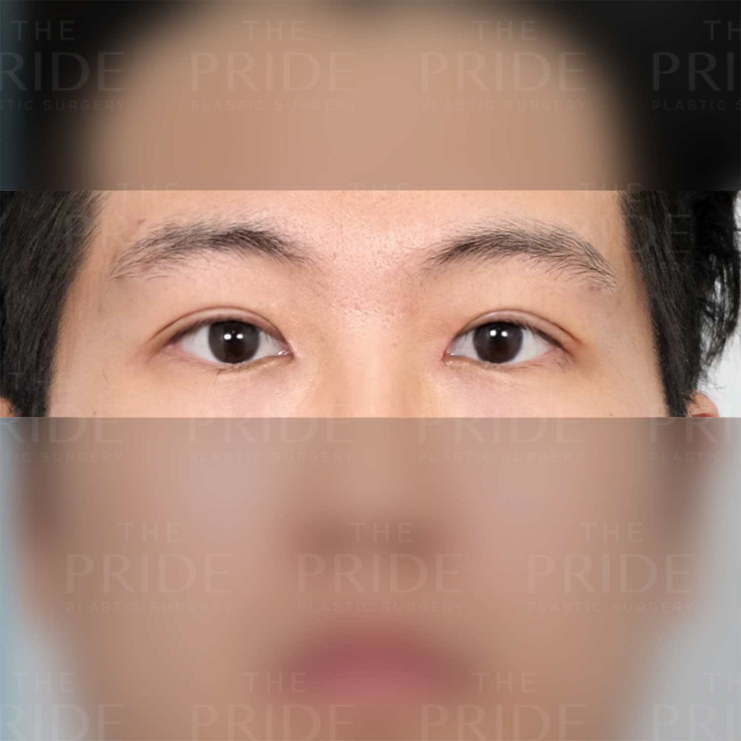 눈성형