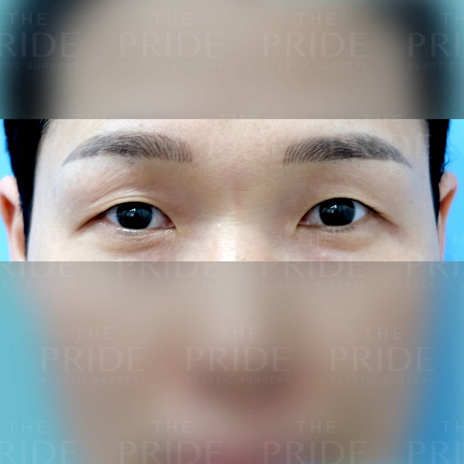 눈성형