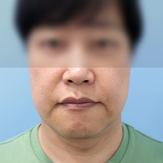 리프팅수술