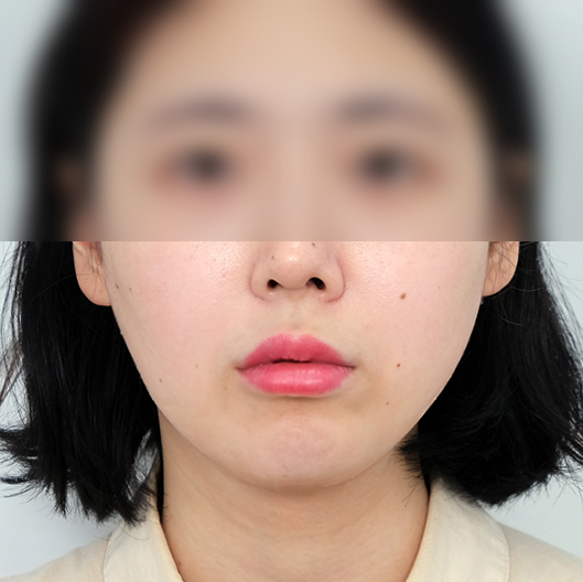 리프팅수술