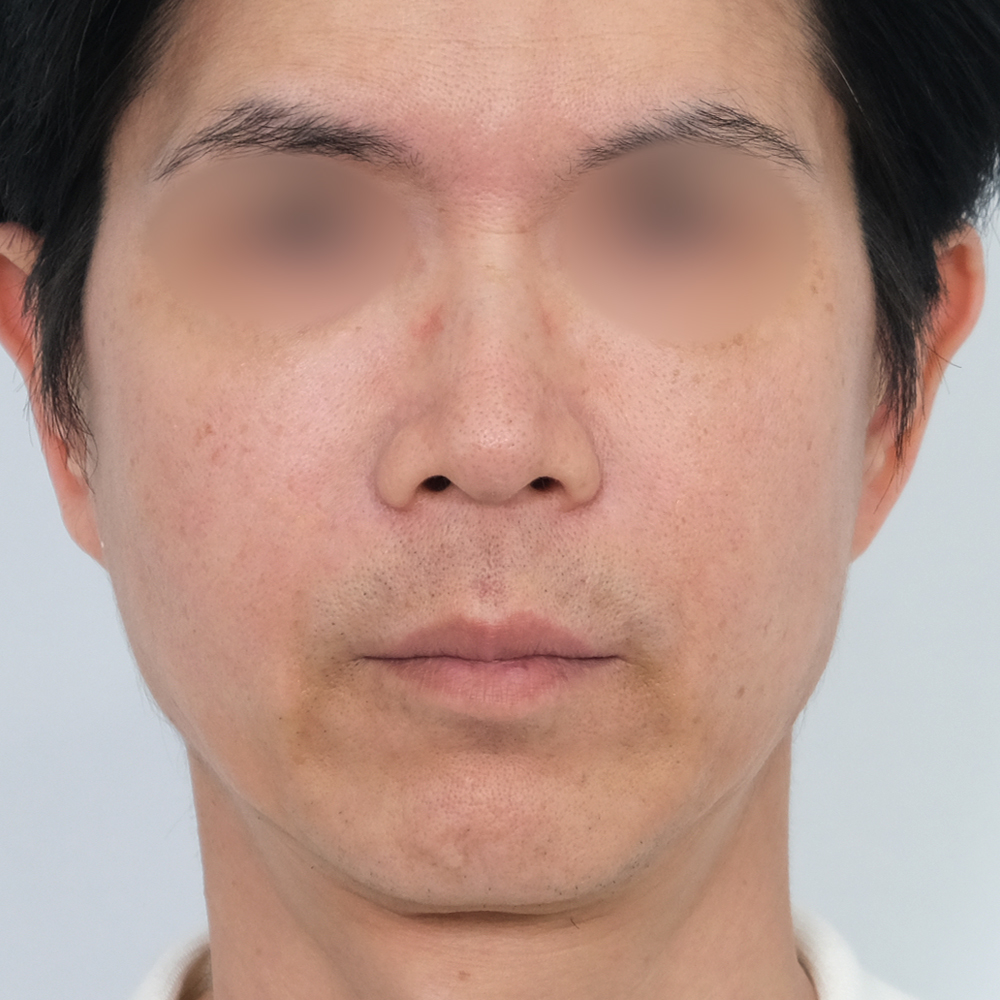 팔자필러