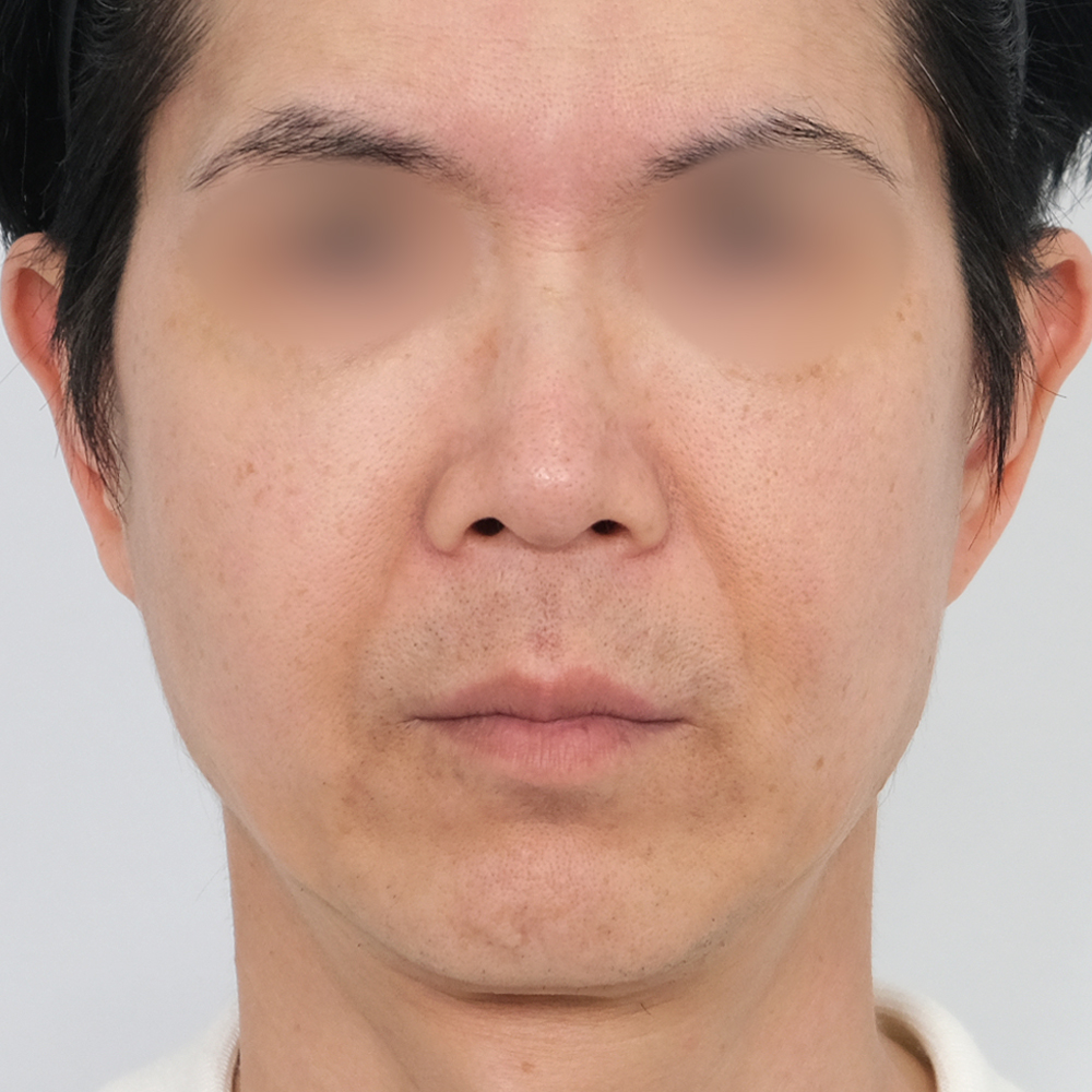 팔자필러