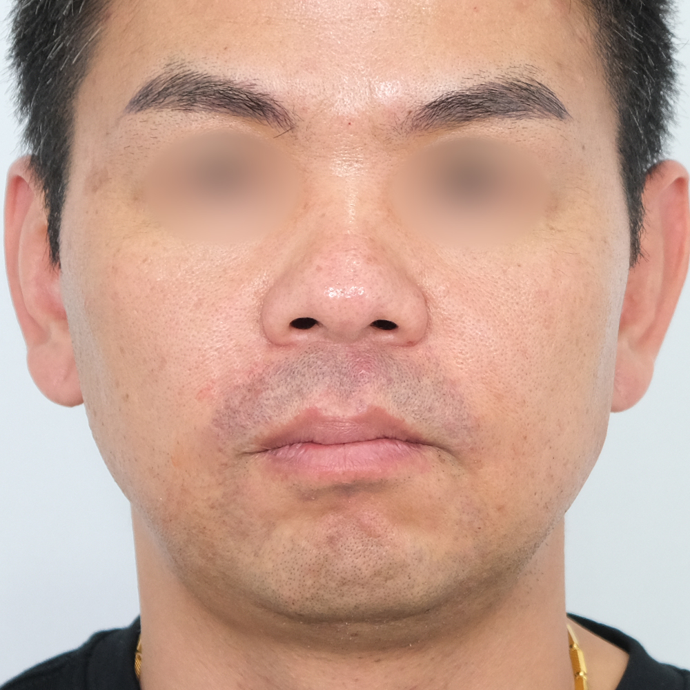 팔자필러