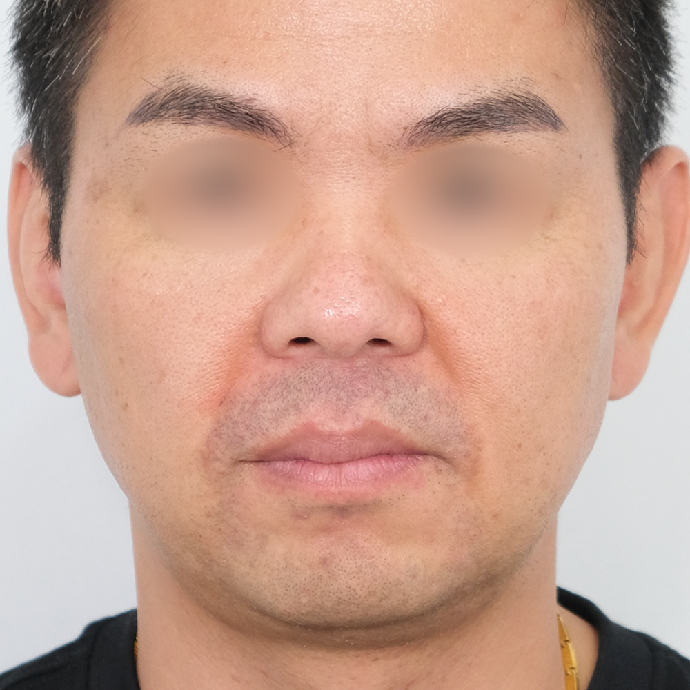팔자필러