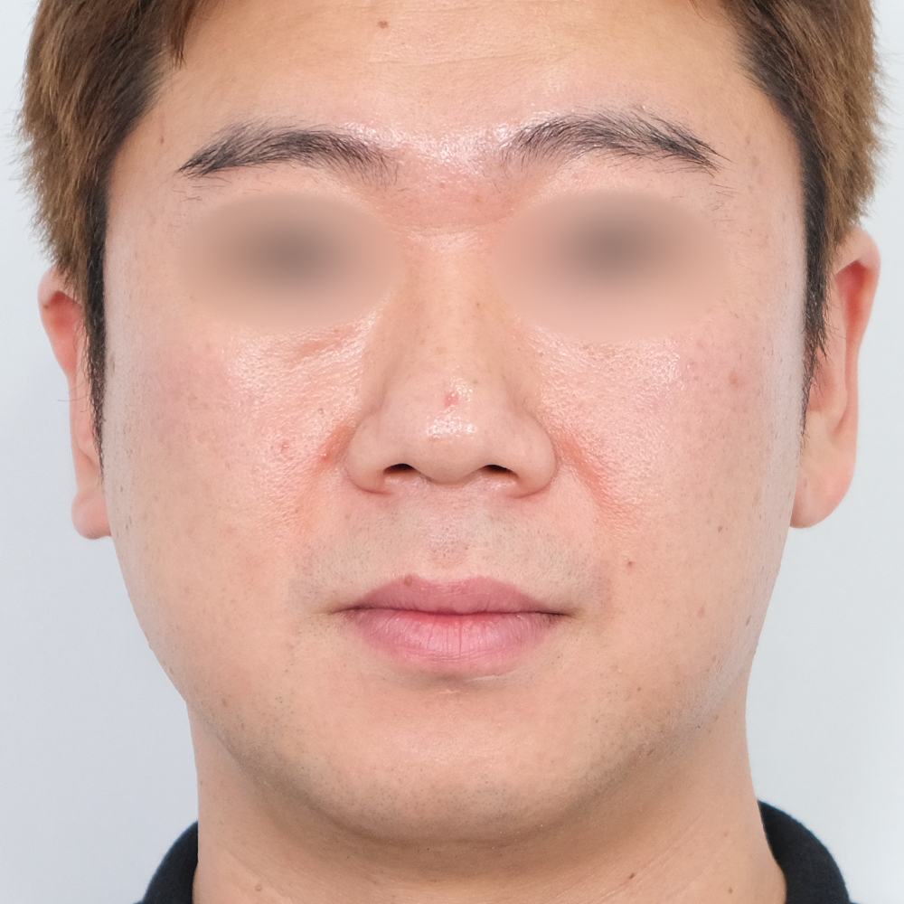 팔자필러