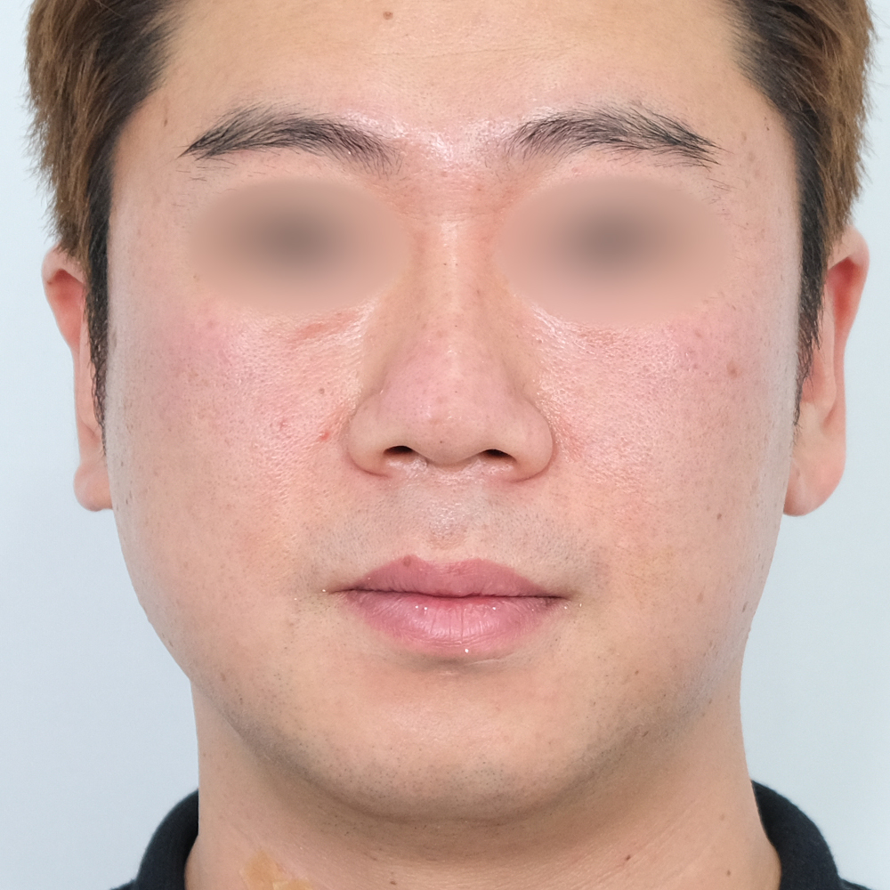 팔자필러