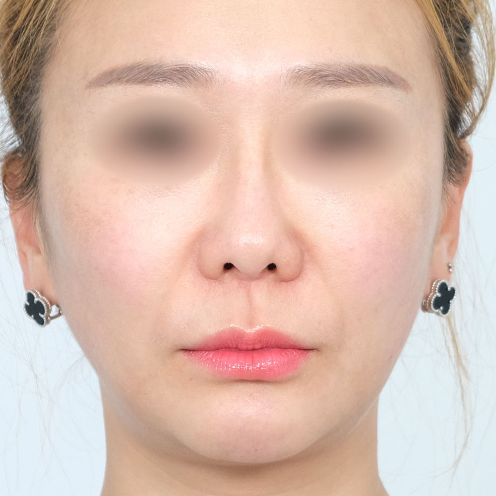 팔자필러